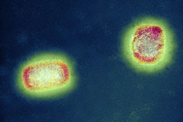 Test rapide de l'antigène: Monkeypox, négligé par le monde, deviendra-t-il la prochaine maladie super infectieuse?